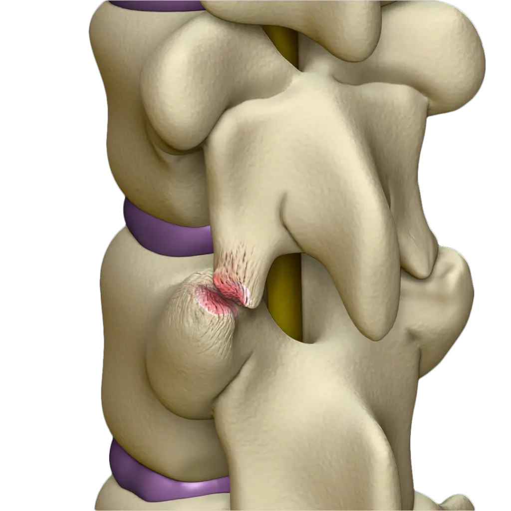 Artrose Facetária