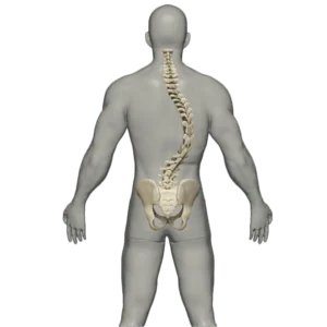 Escoliose