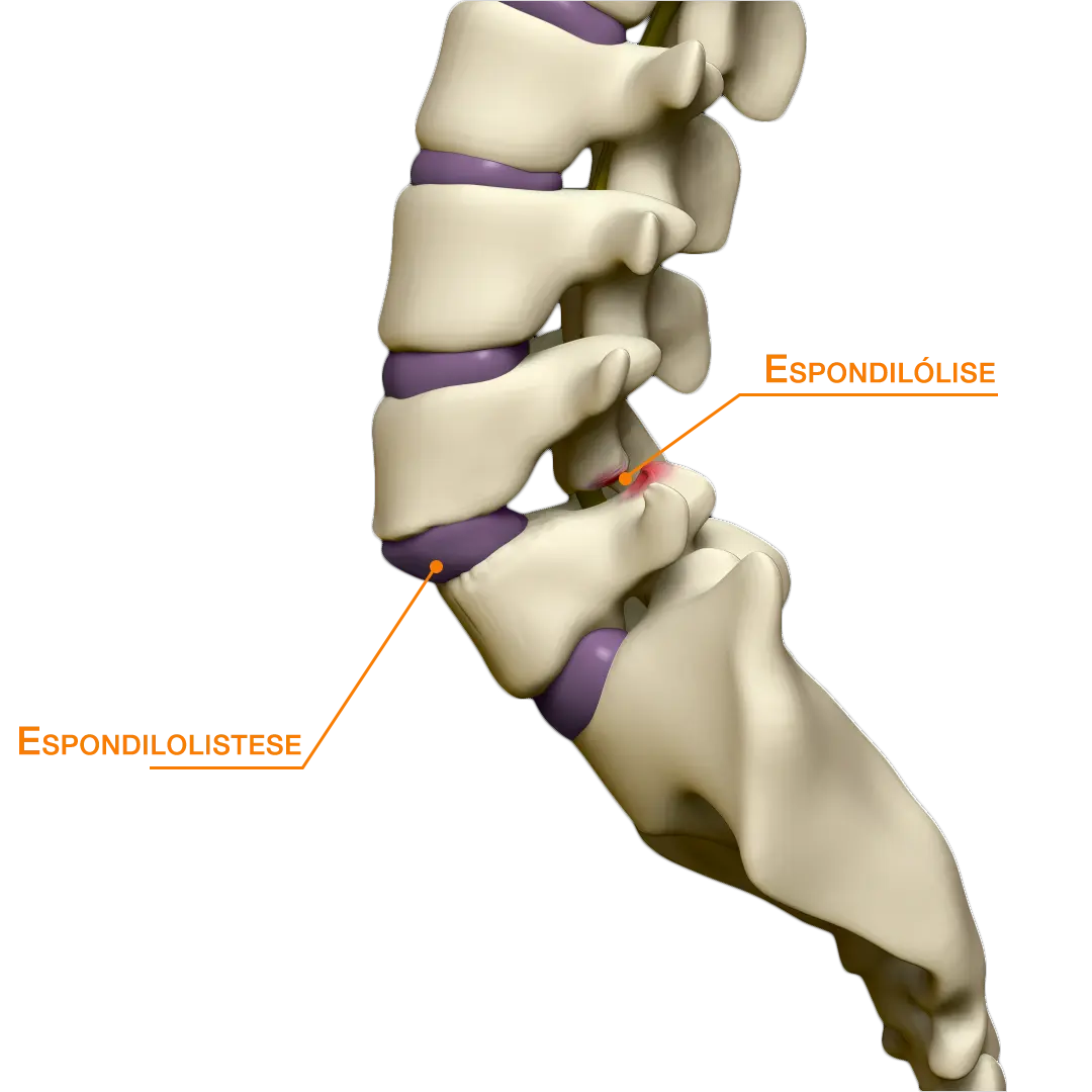 Espondilolistese