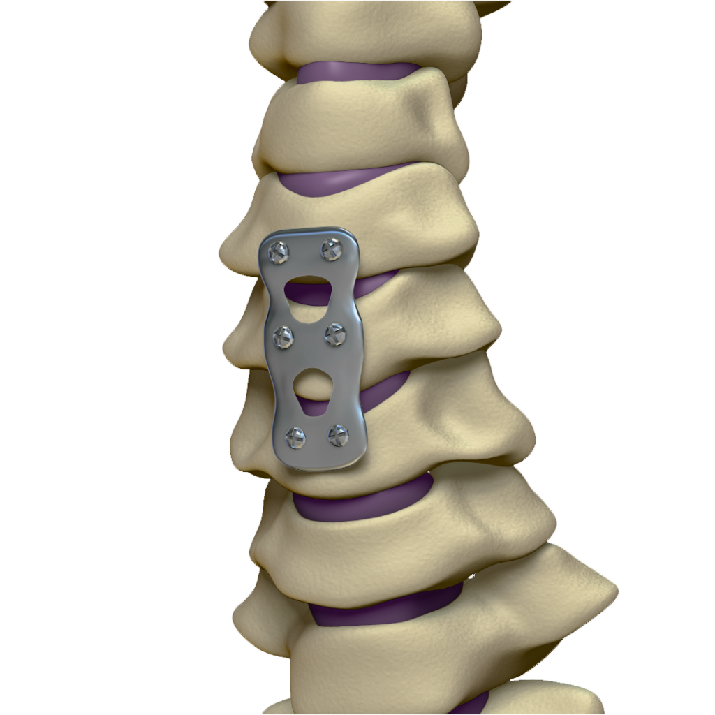 Artrodese Cervical