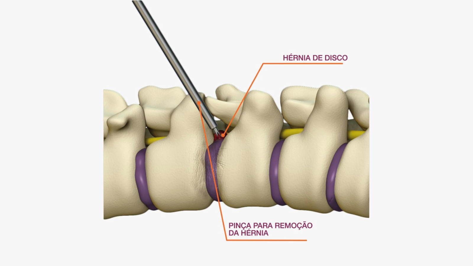 Endoscopia da Coluna