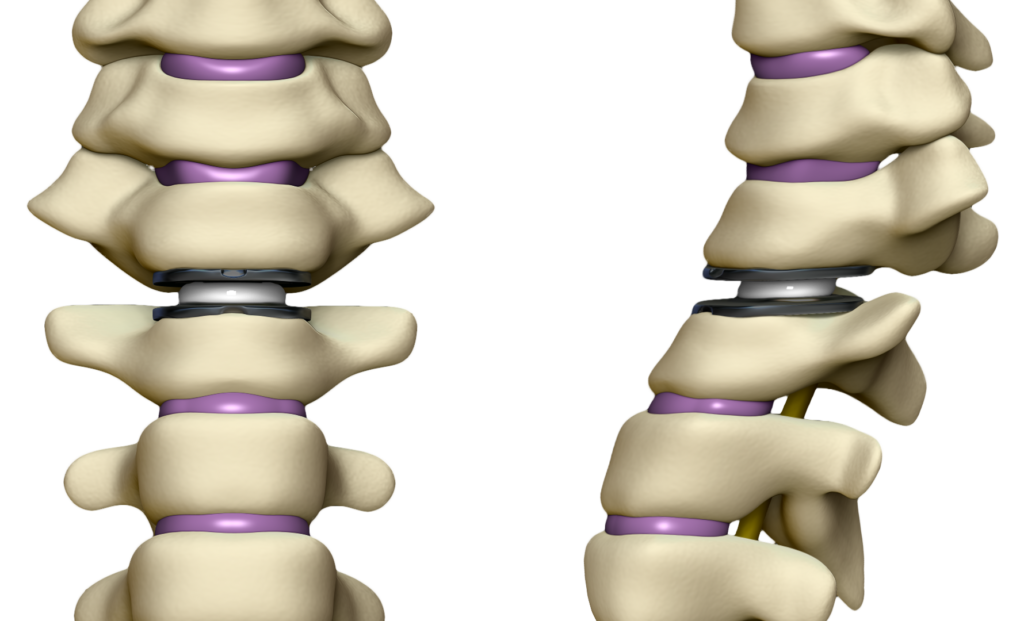Prótese de Disco Cervical