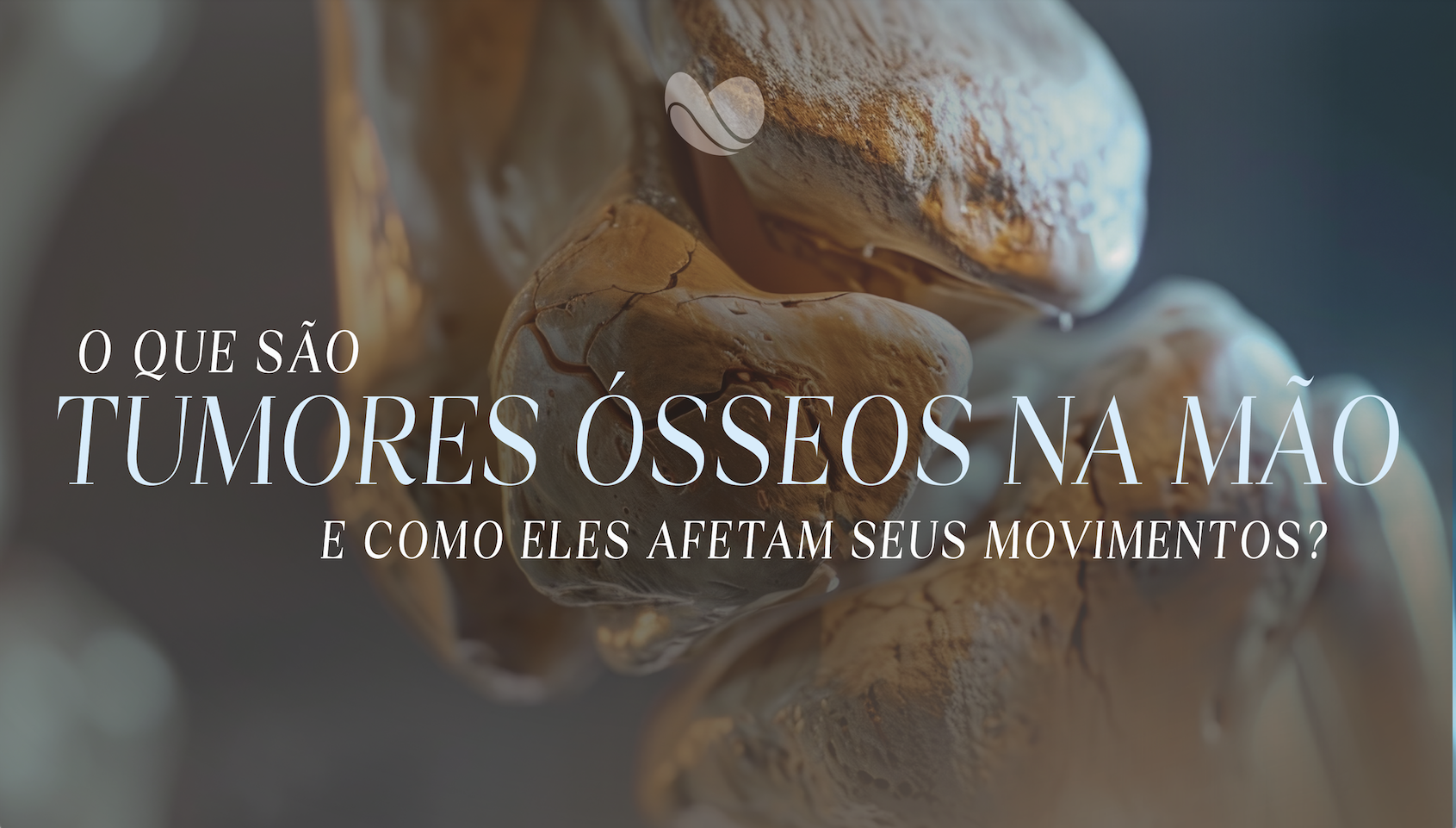O que são tumores ósseos na mão e como eles afetam seus movimentos