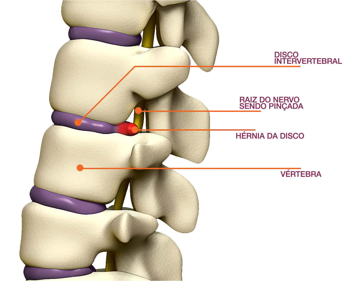 Clínica Atualli - O que é Hérnia de Disco