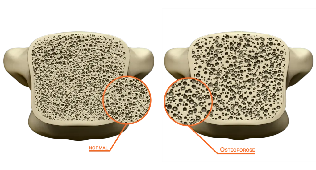 Clínica Atualli -  Osteoporose